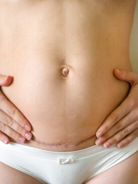 woman with hands on abdomen showing postpartum c-section scar